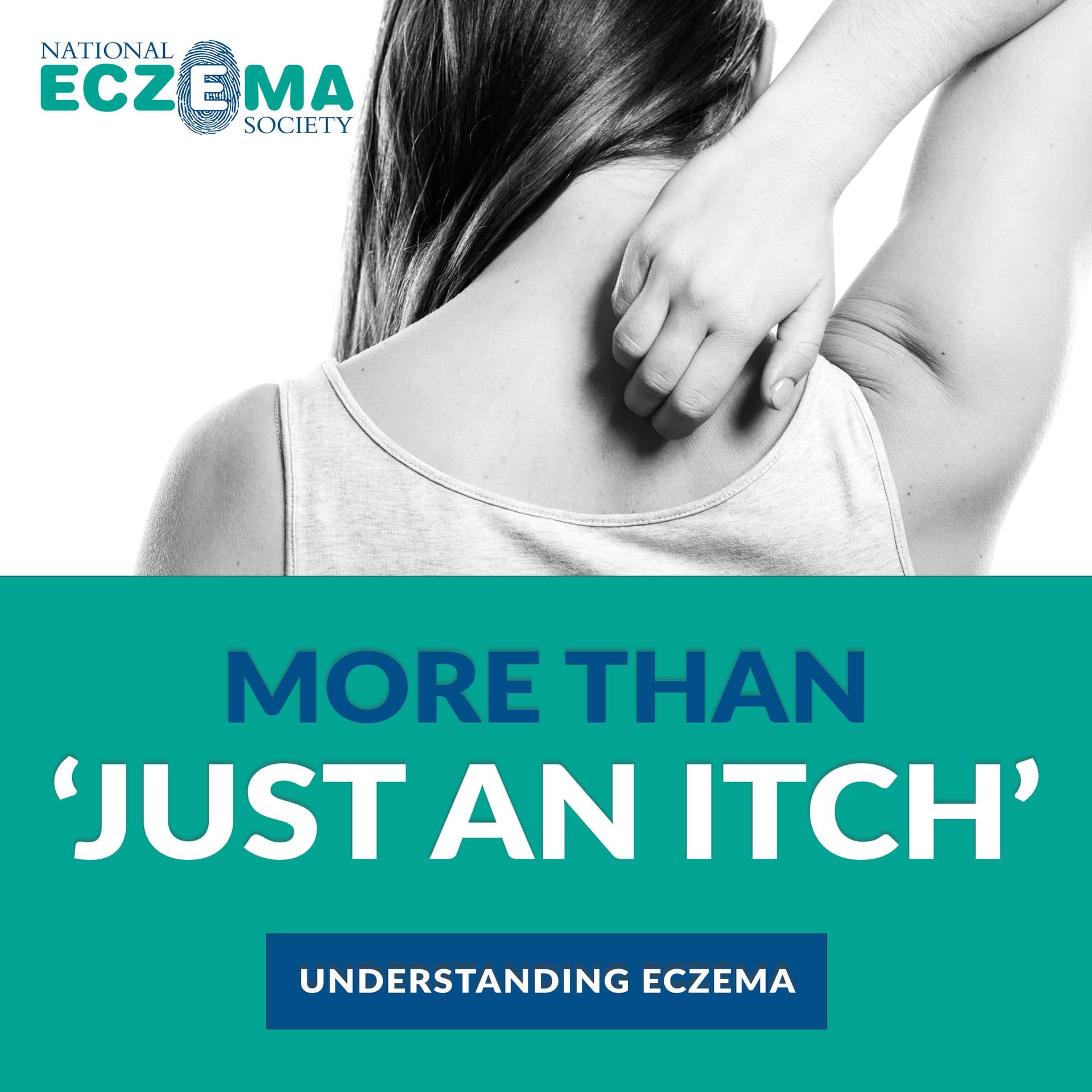 More Than &quot;Just An Itch&quot;: Understanding Eczema